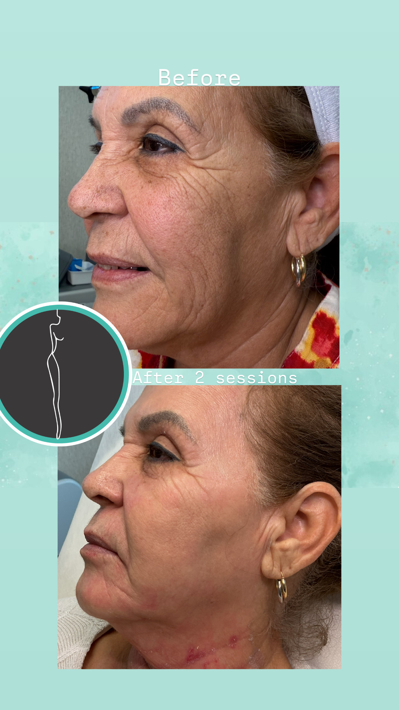 Laser Skin Rejuvenation