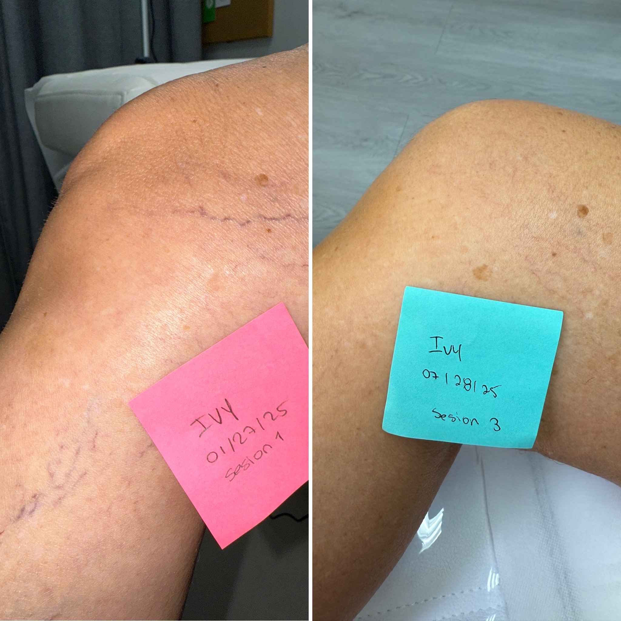 Laser Spider Veins Removal