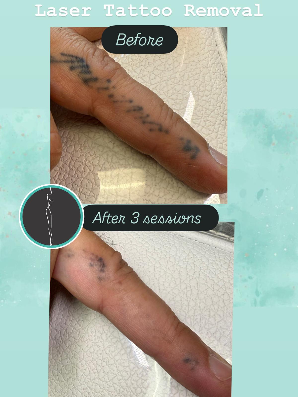 Laser Tattoo Removal